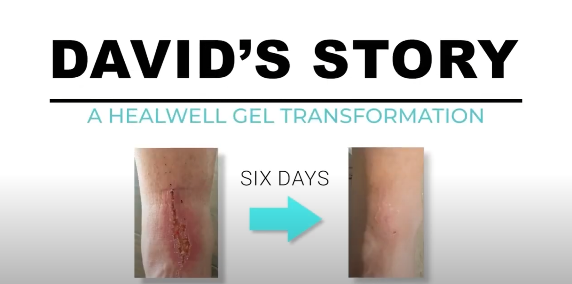 Davids Story, A HealWell Gel Testimonial 2024